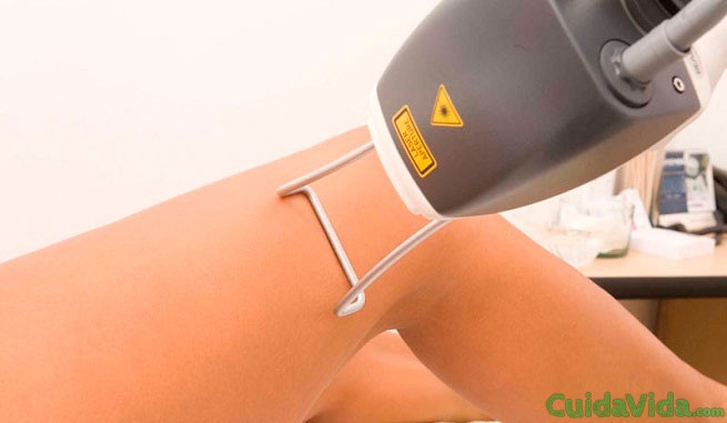 Como funciona la depilacion laser