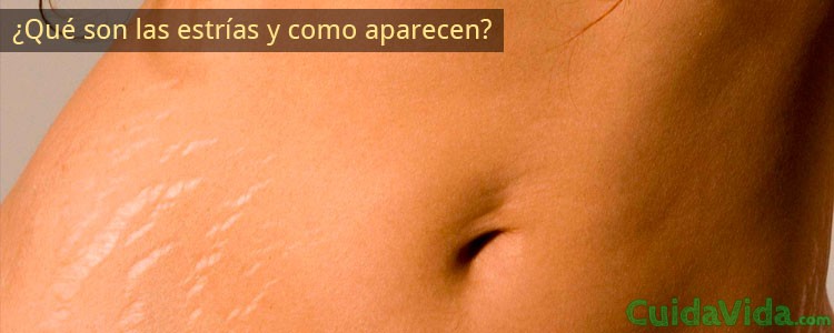 Qué son las estrías