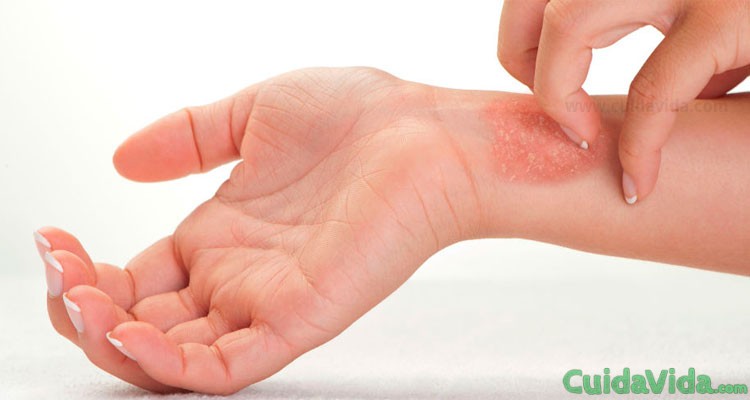 Cómo tratar la dermatitis atópica con remedios caseros
