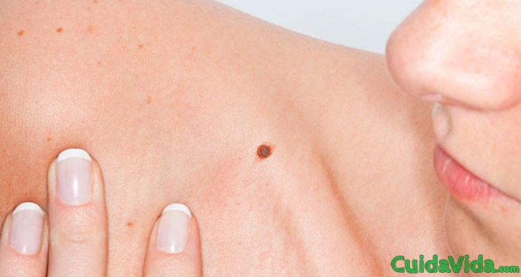 Cómo diagnosticar un melanoma