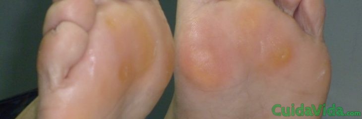 Quien se ha librado del hongo sobre las uñas de los pies