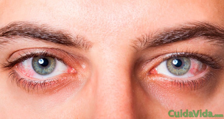 Remedios naturales para curar conjuntivitis